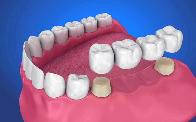 dental bridges in edmonton